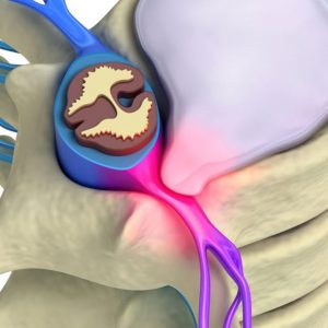 Read more about the article Lumbar disc prolapse: Symptoms and treatment