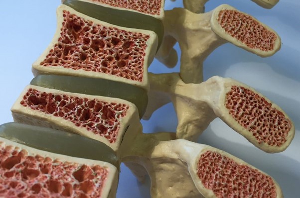 Read more about the article All About Osteoporosis