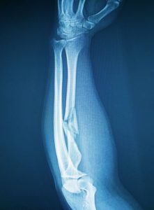 Read more about the article How Osteopathy Can Help You Recover After A Fracture