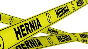 Read more about the article All About Hernias