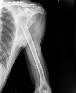 Read more about the article Out of Joint – Shoulder Dislocations